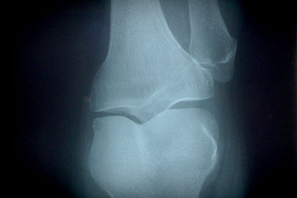 X-ray of knee